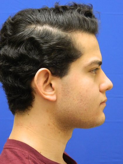 Otoplasty Before & After Patient #1020