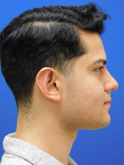 Otoplasty Before & After Patient #1020