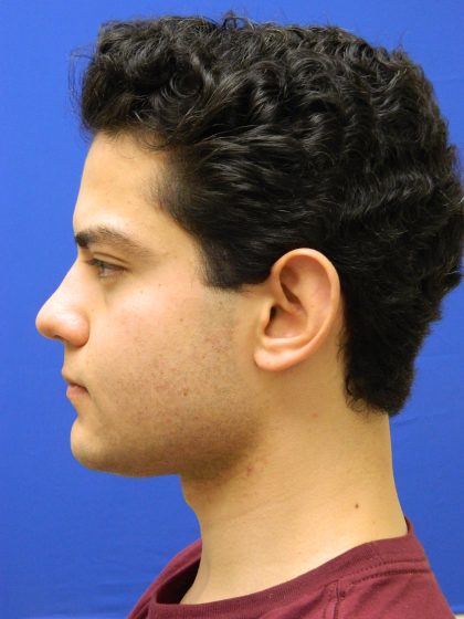 Otoplasty Before & After Patient #1020
