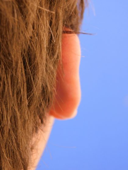 Otoplasty Before & After Patient #1007