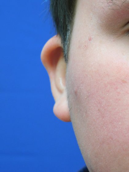 Otoplasty Before & After Patient #1007