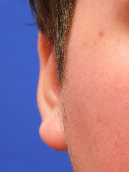 Otoplasty Before & After Patient #1007