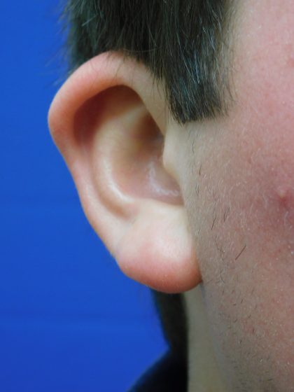 Otoplasty Before & After Patient #1007