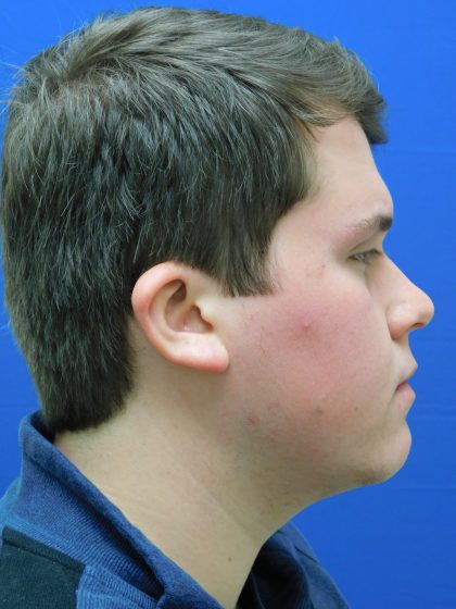 Otoplasty Before & After Patient #1007