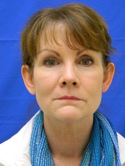 Otoplasty Before & After Patient #1064