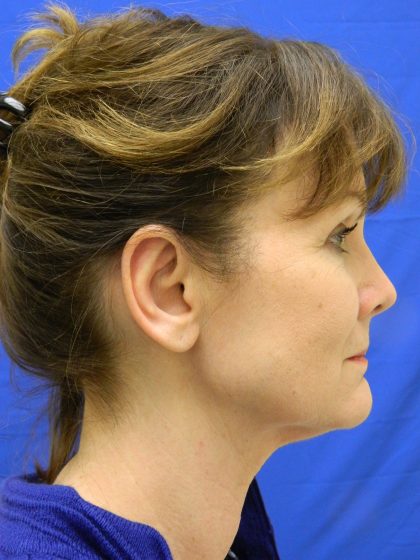 Otoplasty Before & After Patient #1064