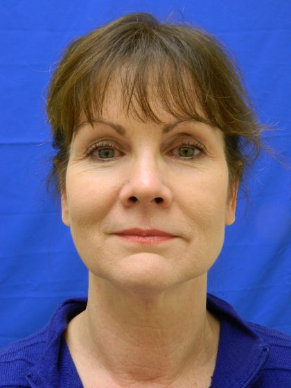 Otoplasty Before & After Patient #1064