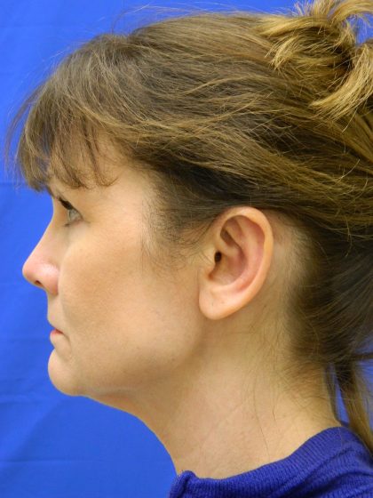 Otoplasty Before & After Patient #1064