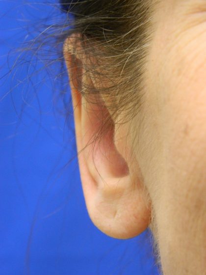 Otoplasty Before & After Patient #1064