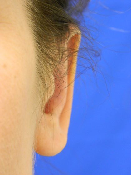 Otoplasty Before & After Patient #1064