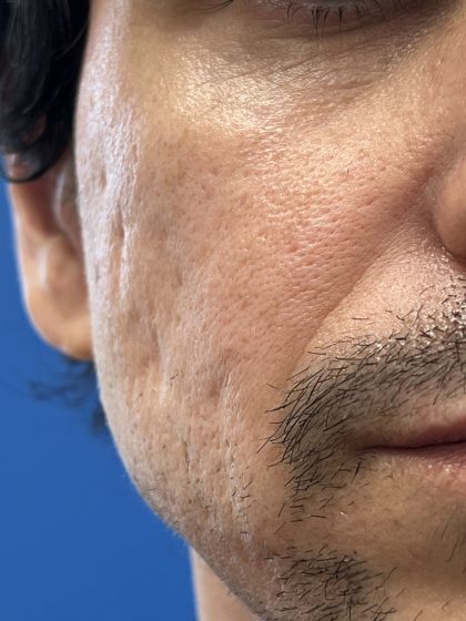 Acne Scarring Before & After Patient #9480
