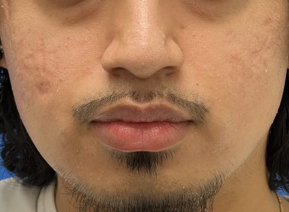 Acne Scarring Before & After Patient #9481