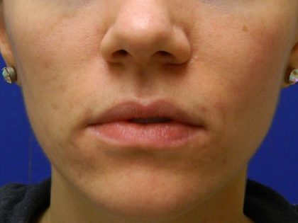 Acne Scarring Before & After Patient #9482