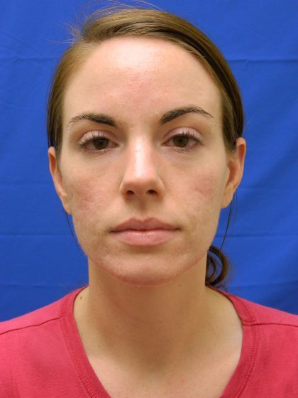 Acne Scarring Before & After Patient #9483