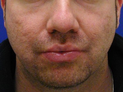 Acne Scarring Before & After Patient #9484