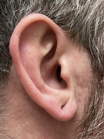 Earlobe Repair Before & After Patient #9537