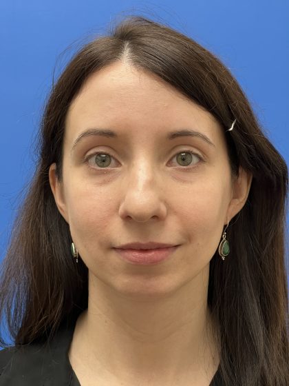 Rhinoplasty Before & After Patient #9544