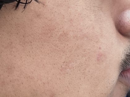 Acne Scarring Before & After Patient #9481