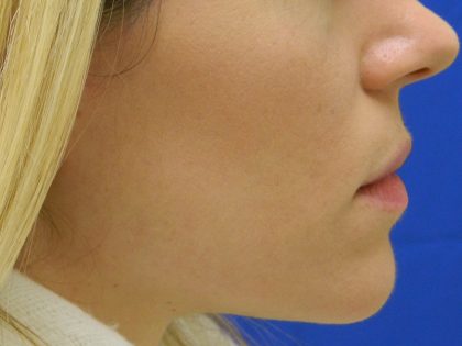 Acne Scarring Before & After Patient #9482
