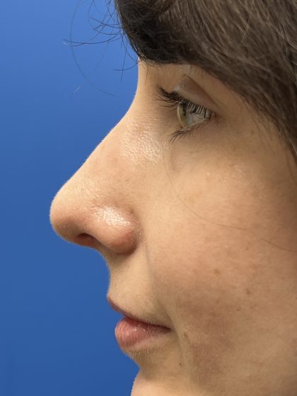 Rhinoplasty Before & After Patient #9544