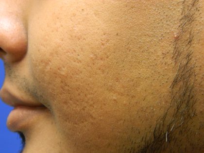 Acne Scarring Before & After Patient #9479