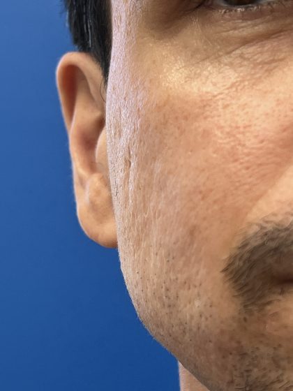 Acne Scarring Before & After Patient #9480