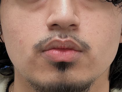 Acne Scarring Before & After Patient #9481