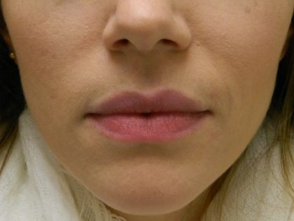 Acne Scarring Before & After Patient #9482