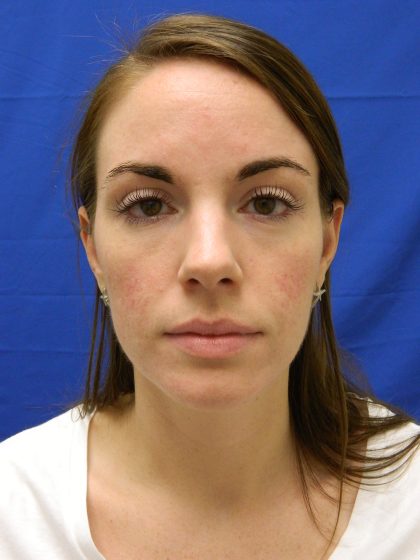 Acne Scarring Before & After Patient #9483
