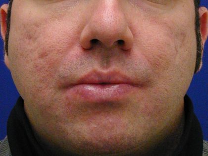 Acne Scarring Before & After Patient #9484