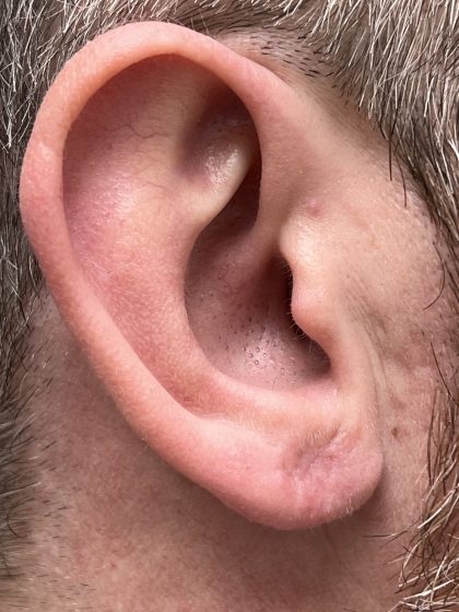 Earlobe Repair Before & After Patient #9537