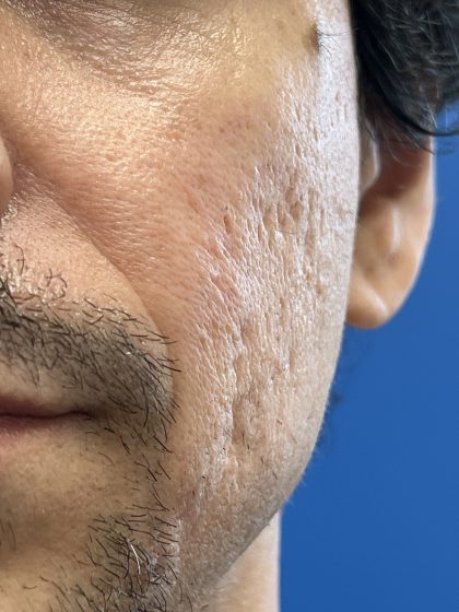 Acne Scarring Before & After Patient #9480
