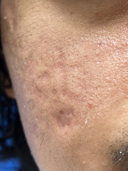 Acne Scarring Before & After Patient #9481
