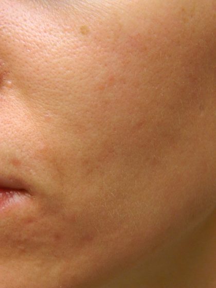 Acne Scarring Before & After Patient #9482