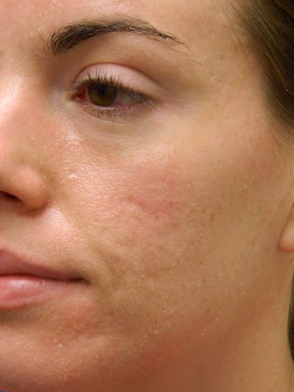Acne Scarring Before & After Patient #9483
