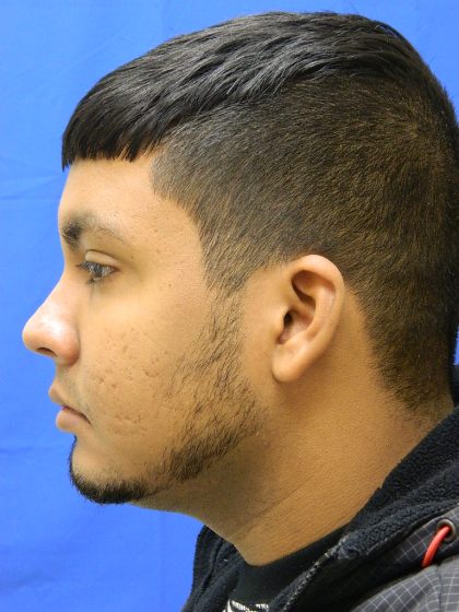 Acne Scarring Before & After Patient #9479