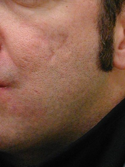 Acne Scarring Before & After Patient #9484