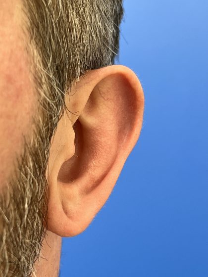 Earlobe Repair Before & After Patient #9537