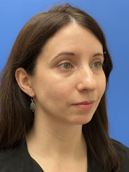 Rhinoplasty Before & After Patient #9544
