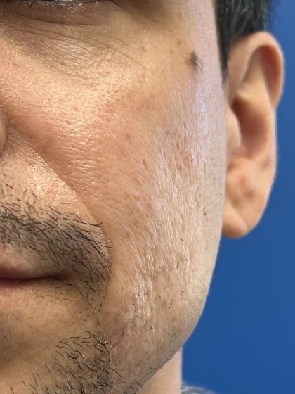 Acne Scarring Before & After Patient #9480