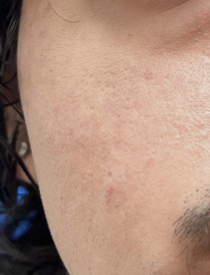 Acne Scarring Before & After Patient #9481