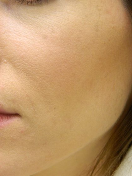 Acne Scarring Before & After Patient #9482