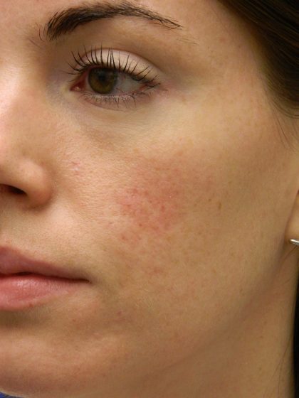 Acne Scarring Before & After Patient #9483