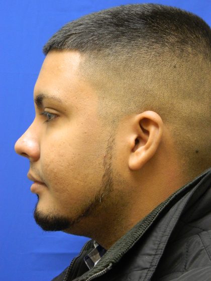 Acne Scarring Before & After Patient #9479