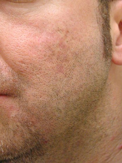 Acne Scarring Before & After Patient #9484