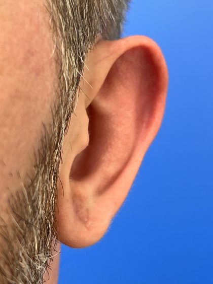 Earlobe Repair Before & After Patient #9537