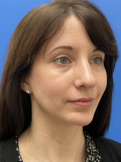 Rhinoplasty Before & After Patient #9544
