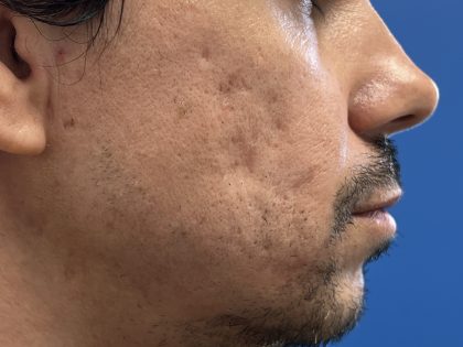 Acne Scarring Before & After Patient #9480