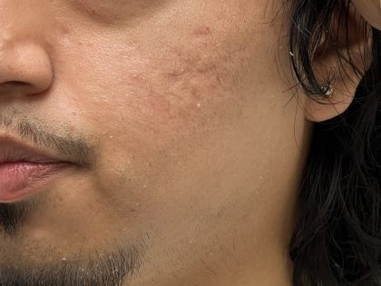 Acne Scarring Before & After Patient #9481