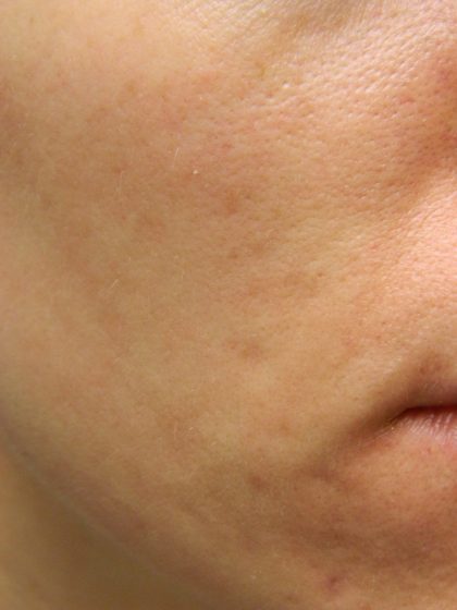 Acne Scarring Before & After Patient #9482